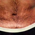 Tummy Tuck Male Before & After Patient #3084