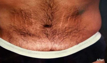 Tummy Tuck Male Before & After Patient #3084