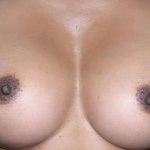 Breast Augmentation Before & After Patient #2213