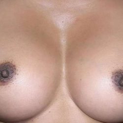 Breast Augmentation Before & After Patient #2213