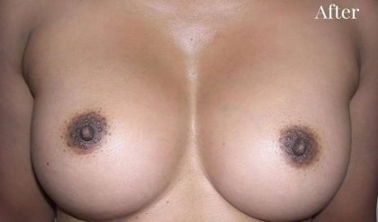 Breast Augmentation Before & After Patient #2213