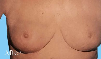 Breast Lift Before & After Patient #2294