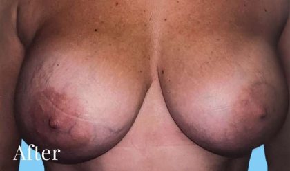 Breast Revision Before & After Patient #2369