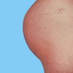 Buttock Augmentation Male Before & After Patient #2468