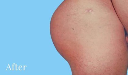 Buttock Augmentation Male Before & After Patient #2468