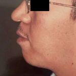 Chin Implants Before & After Patient #2477