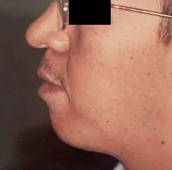 Chin Implants Before & After Patient #2477