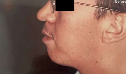 Chin Implants Before & After Patient #2477