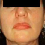 Chin Liposuction Before & After Patient #2486