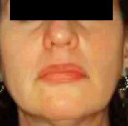 Chin Liposuction Before & After Patient #2486