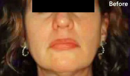 Chin Liposuction Before & After Patient #2486