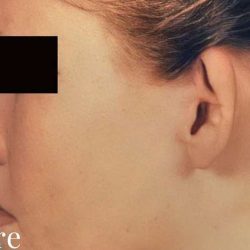 Otoplasty Before & After Patient #2556