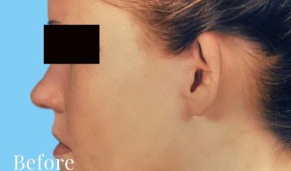 Otoplasty Before & After Patient #2556