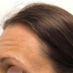 Eyebrow Restoration Before & After Patient #2570