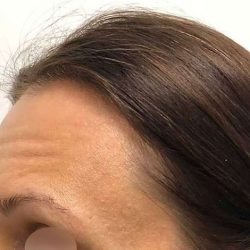 Eyebrow Restoration Before & After Patient #2570