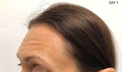 Eyebrow Restoration Before & After Patient #2570
