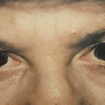 Eyelid Surgery Before & After Patient #2608