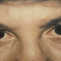 Eyelid Surgery Before & After Patient #2608