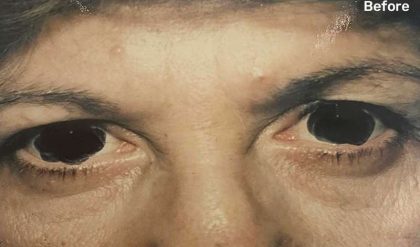 Eyelid Surgery Before & After Patient #2608