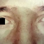 Eyelid Surgery Male Before & After Patient #2632