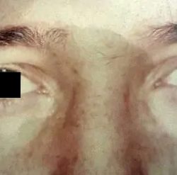 Eyelid Surgery Male Before & After Patient #2632