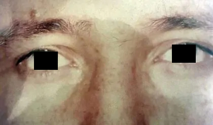 Eyelid Surgery Male Before & After Patient #2632