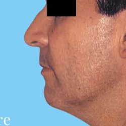 Facelift Male Before & After Patient #2668