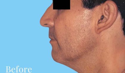 Facelift Male Before & After Patient #2668