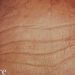 Botox Male Before & After Patient #2166