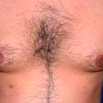 Gynecomastia Before & After Patient #2707