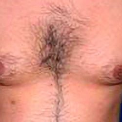 Gynecomastia Before & After Patient #2707