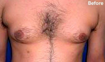 Gynecomastia Before & After Patient #2707