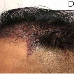Hair Restoration Before & After Patient #2757