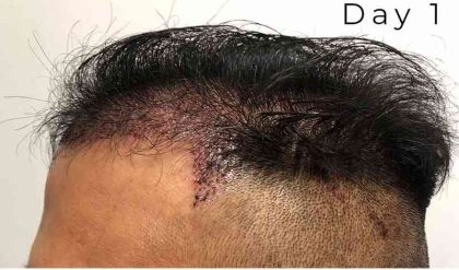 Hair Restoration Before & After Patient #2757