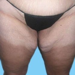 Liposuction Before & After Patient #2835