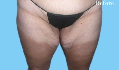 Liposuction Before & After Patient #2835
