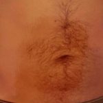 Liposuction Male Before & After Patient #2894