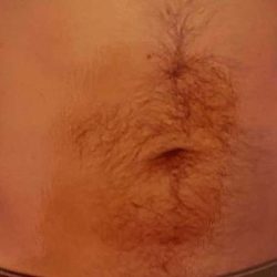 Liposuction Male Before & After Patient #2894