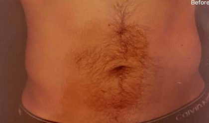 Liposuction Male Before & After Patient #2894
