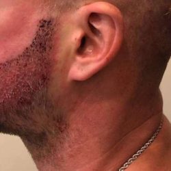 Beard Restoration Before & After Patient #2151