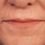 Microneedling Before & After Patient #2924