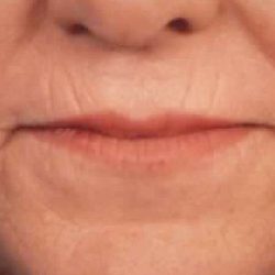 Microneedling Before & After Patient #2924