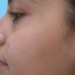 Rhinoplasty Before & After Patient #2967