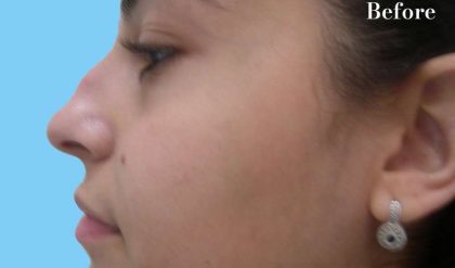 Rhinoplasty Before & After Patient #2967