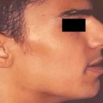 Rhinoplasty Male Before & After Patient #3015
