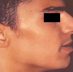 Rhinoplasty Male Before & After Patient #3015
