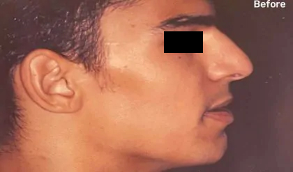 Rhinoplasty Male Before & After Patient #3015