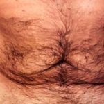 Tummy Tuck Male Before & After Patient #3084