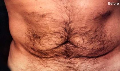 Tummy Tuck Male Before & After Patient #3084