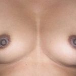 Breast Augmentation Before & After Patient #2213
